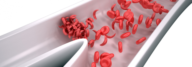 Gene therapies for sickle cell disease come with hope and challenges